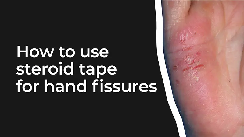 How to use steroid tape for hand fissures