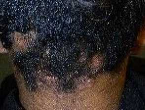 Ingrown Hair Removal How to Get Rid Of Ingrown Hairs  Mens Health
