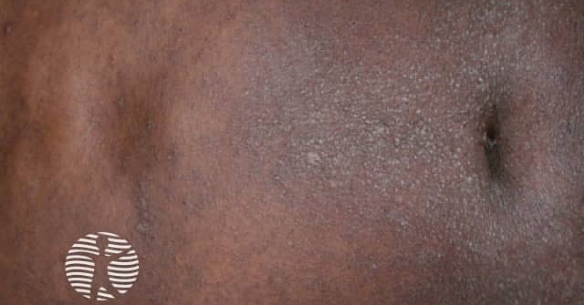 scabies 7 image