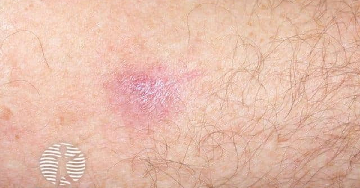 lymphocytoma2 image