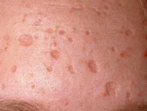 chickenpox scars s