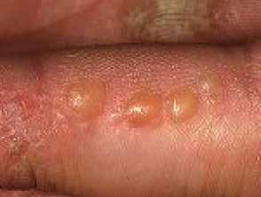 dyshidrotic eczema dyshidrotic dermatitis