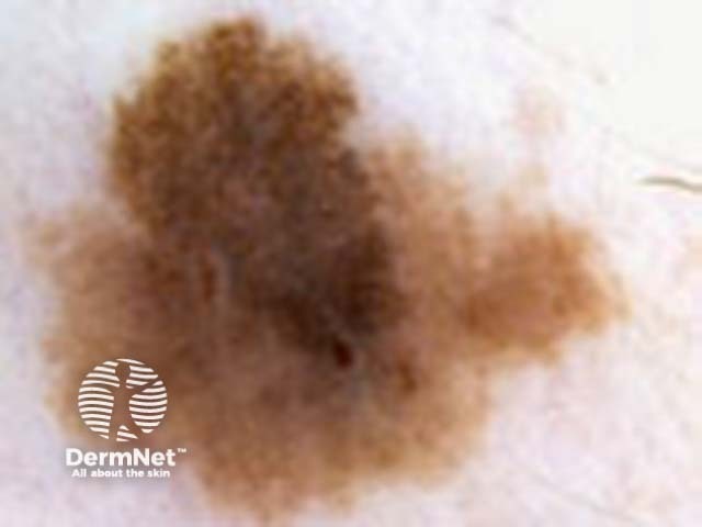 Superficial spreading malignant melanoma - an enlarging pigmented lesion with variable pigmentation, irregular edge, and asymmetry