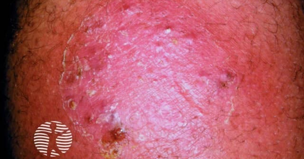 Majocchi Granuloma Image
