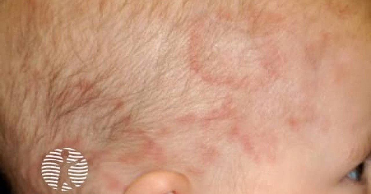 Neonatal Lupus