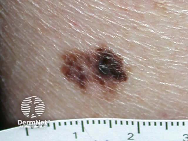 Superficial spreading malignant melanoma - irregular border, variable pigmentation, and areas of clinical regression