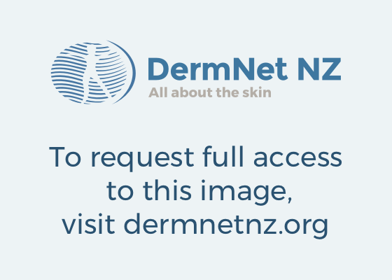 Dermatoscopia: reticular naevus