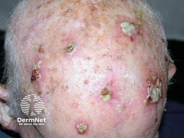 Multiple squamous cell carcinomas on the scalp