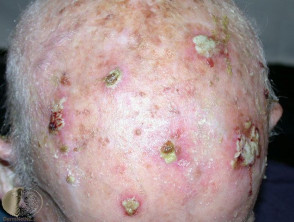Multiple squamous cell carcinomas on the scalp