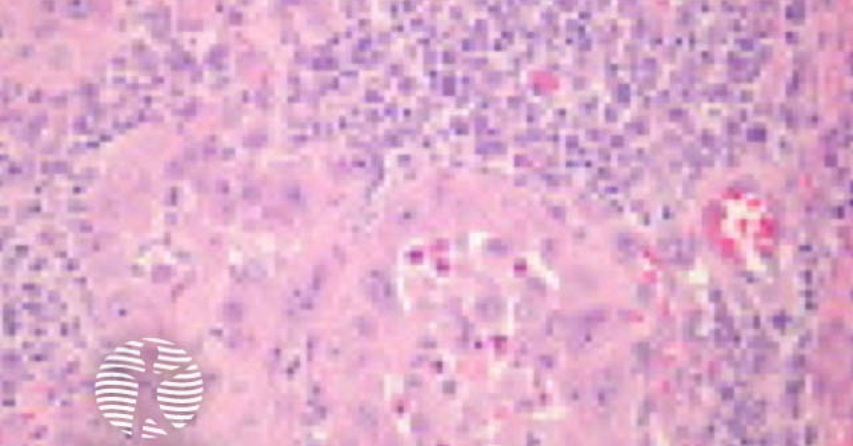 inflammatory scc fig 33 sm image