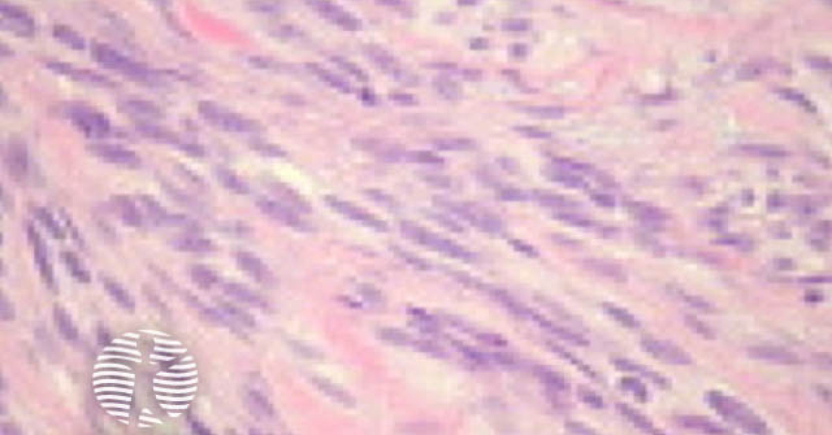 spindle cell scc fig 12 sm image