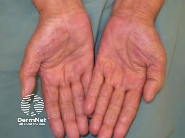 Hand-foot reaction