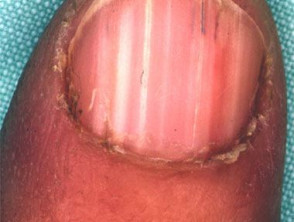 Darier nail disease