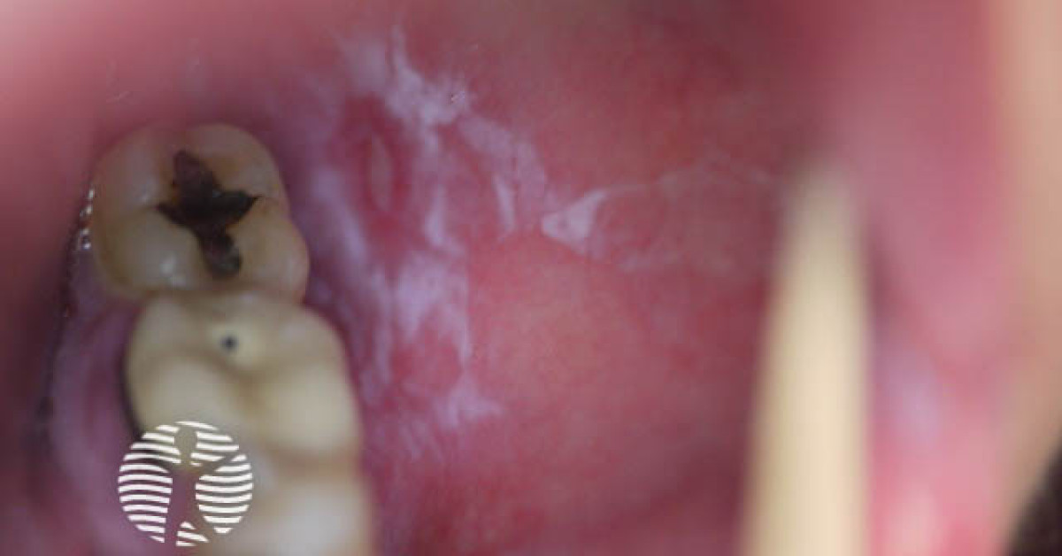 oral lichen planus1 s image