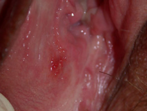 vulval ulcer2