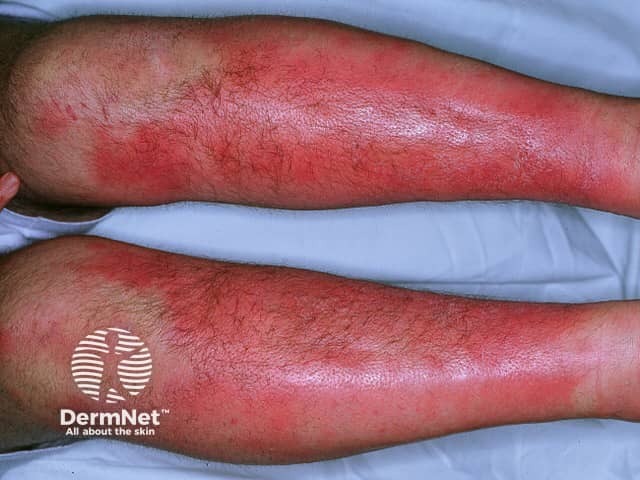Erythema Nodosum Face Erythema Nodosum Stock Image C044 3058