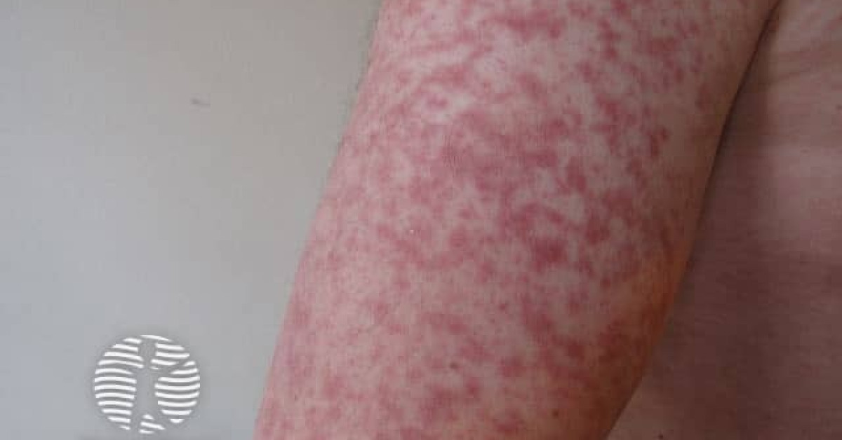 measles09 image